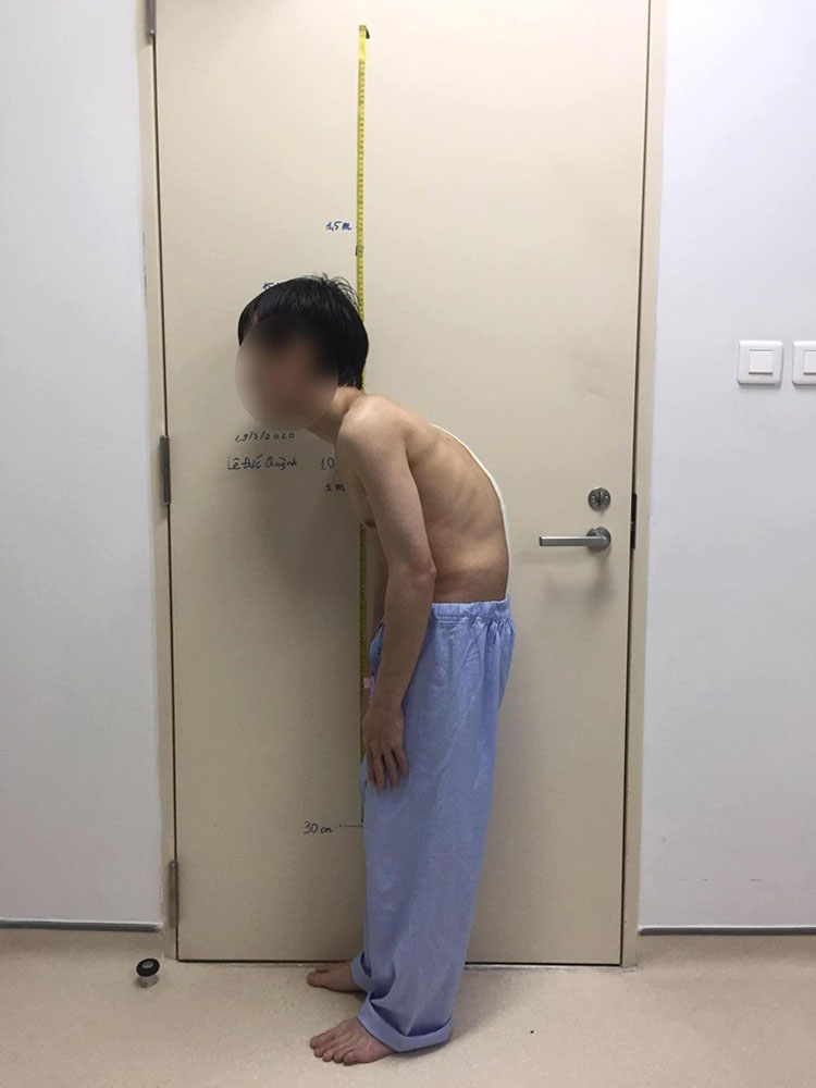 Sau phẫu thuật, bệnh nhân cao hơn 34cm.